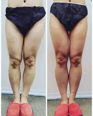 【痩身】特許取得のWキャビテーション＆超音波で脂肪が溶けて流れて更に筋肉を引き締めます！