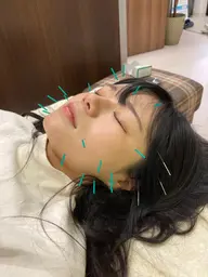 美顔はり×40分