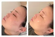 幹細胞にアプローチし、お肌を根本改善💖毛穴の開き、乾燥、ツヤ不足など一人一人の気になるお肌悩みを良い状態へ