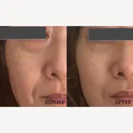 【贅沢フルコース】サーマトリックス×毛穴洗浄×幹細胞導入¥55,220→¥35,000