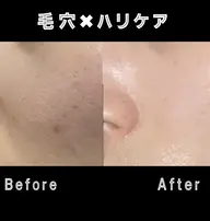 【毛穴・陶器肌】全顔脱毛❣️二段階シェービング付✨光フェイシャルで美白に✨メイク乗りUP❣️