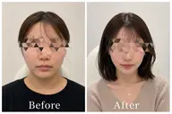 小顔矯正×ララピール✨輪郭を作りたい、肌質改善したい方必見🫶🏻