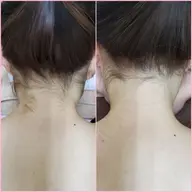 襟足・うなじ  脱毛