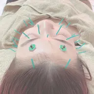 🔰✨お顔スッキリ✨　　　　　　　　　　　　　　　　　美容鍼ノーマルケアコース（お顔のみ）