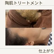 ハーブピーリング🌿剥離なしダウンタイムなしの大人気メニューです。