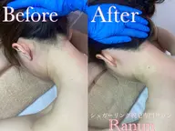 【プチ垢抜け★】うなじ+もみあげ+背中上シュガーリング脱毛3点セット 毛穴洗浄付き