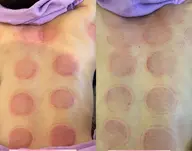 溜め込み脂肪を撃退！RF温熱＆真空カッピング・本気の全身浄化