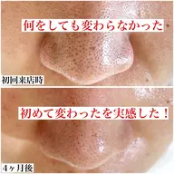 毛穴ケア基礎コース60分 (頑固な角栓、ざらざらのざらつき肌、ベトベトテカリ肌)