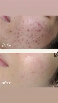 人気No.1❤️【剥離有り】ハーブピーリング＋毛穴集中ケア＋鎮静パック＋LED照射🌿繰り返すニキビには断然オススメ✨✨