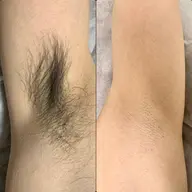 【男性】脇ダブル脱毛¥7,900 面倒な自己処理一切不要⭕️ワックス✖️光脱毛でその場でツルツル♪初めての脱毛お試しにも