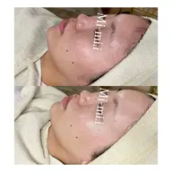 【艶肌WAX】毛穴、産毛、角質、顔ダニさようなら🫶🏻艶肌フェイシャルワックス脱毛♡産毛が無くなる=毛穴が無くなる！