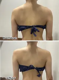 👤肩こりをスッキリ👤3D超音波リフト4000shot!!レディースメンズok👌❤️