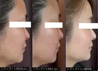 30～40代に大人気【ほうれい線/たるみ/二重顎】韓国リフト+小顔矯正モニター¥10800