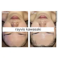 24歳以下限定🌸新生活応援!!白玉ピーリングで垢抜け透明感✨毛穴・美白フェイシャル体験¥1980