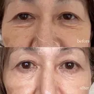 【目元ケア】切らないクマ取り・たるみ改善特化 ◆韓国IR管理 ¥5,500