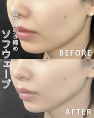 【最強小顔】Vリフト×高濃度ハリ成分×プラズマ導入でたるみ・小じわ改善