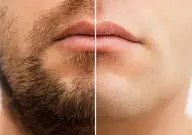 【先着3名様限定】メンズひげ脱毛6回モニター　通常￥46,200→￥30,000