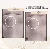 【モニター限定】鼻周りのみの集中毛穴洗浄☆施術前後の写真・動画撮影・ネット掲載OK・口コミの記入をして下さる方のみ。