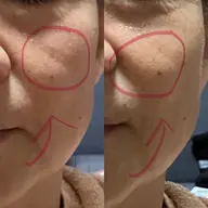 【憧れ小顔】✨リフトアップ超音波エステ💆‍♀️キメを整え、たるみ、シミシワにもアプローチ。