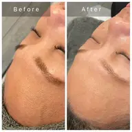 【✨1日1名様限定✨】最強小顔SET+ブラックピール‼️