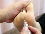 【ドイツ式フットケア】魚の目、タコ除去2か所まで　40分  ￥7,000→￥4.200