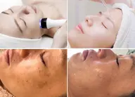 【肝斑ケア】エステでは不可能なシミ、ぼやけたシミを特許美顔術でケア