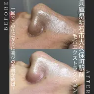 🌱初回限定。毛穴エクストラクション全顔(光フェイシャル付き)メンズも施術可能🉑