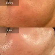 針、メスなし❤️毛穴修復スペシャル⭐️生コラーゲン注入付き【大きい毛穴、たるみ凸凹毛穴ケア】お茶カウンセリング込120分