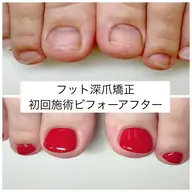 ミニモ限定🦶【むしり癖・でこぼこ爪】🌿フット深爪矯正《ケア＋長さ出し＋ワンカラー仕上げ》