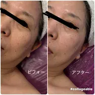 ホワイトビーナスエステで透明感爆誕⛄️期間限定エステ💆‍♀️