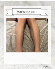 新規様　初回男性🚹全身脱毛9.000円