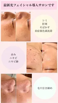 光エステでシミ取り肌質改善!