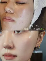 ☘️ご新規様限定🌿透明感UP✨剥離なしハーブピーリング