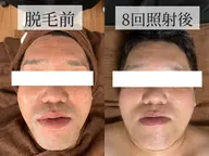 🚹【メンズ全顔脱毛】1回のみの使用可能です☘️お顔のトーンアップ、毛穴開きの改善、肌荒れ防止にも繋がります🌟