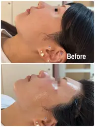 【小顔リフト】顎下、二重顎、フェイスライン輪郭、浮腫ケア