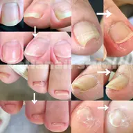 不快感スッキリ単発【巻爪カット】