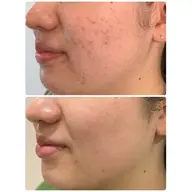 ハイドラフェイシャル☆毛穴洗浄☆+悩み別耳つぼジュエリー付き