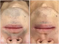 【新規男性/人気NO.1/短期間でカミソリいらず】ひげ光脱毛体験¥2200