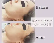 お肌悩みに合わせた特殊な光を照射💡光フェイシャルフルコース☆ 105分