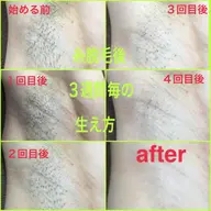 両脇の糸脱毛体験🧵