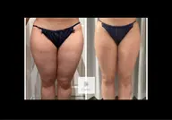 痛みゼロ👌脂肪排泄（お腹.足.背中）