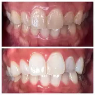 【短期間で白くしたい方♪】セルフホワイトニング15分✖︎3回セット