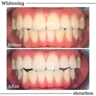 【初回限定】クリーニングジェルホワイトニング 3照射