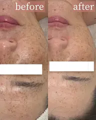 【ツヤ肌ピーリング】ラミネーションピール×ハイドロジェリーマスク