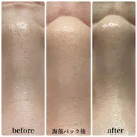 【平日限定/この春褒められる肌作り】全顔3D毛穴洗浄+顔無VIO込全身脱毛¥11,500