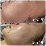 二重顎、ほうれい線、くすみ肌【小顔美肌フェイシャル】ハーブ×ハイパーナイフフェイシャル ¥18,700→¥14,000