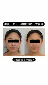 ✨極上小顔✨究極の3パーツ小顔矯正💆♀️一回で劇的な変化をお望みの方はこちらがオススメ💗80分