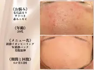 学生限定《皮膚科通いの方🏥》薬を止めると出てくるニキビ😭からの解放🌸集中ケアパックで根本改善で徹底アプローチ👀