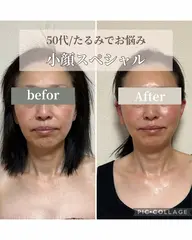 【モニター3名様募集】エイジングケア付小顔3回数券