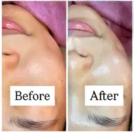 ◇肌質改善◇🧚ピーリング、むくみ撃退、つや肌美容液導入🫧/贅沢たっぷり80分コース💆‍♀️